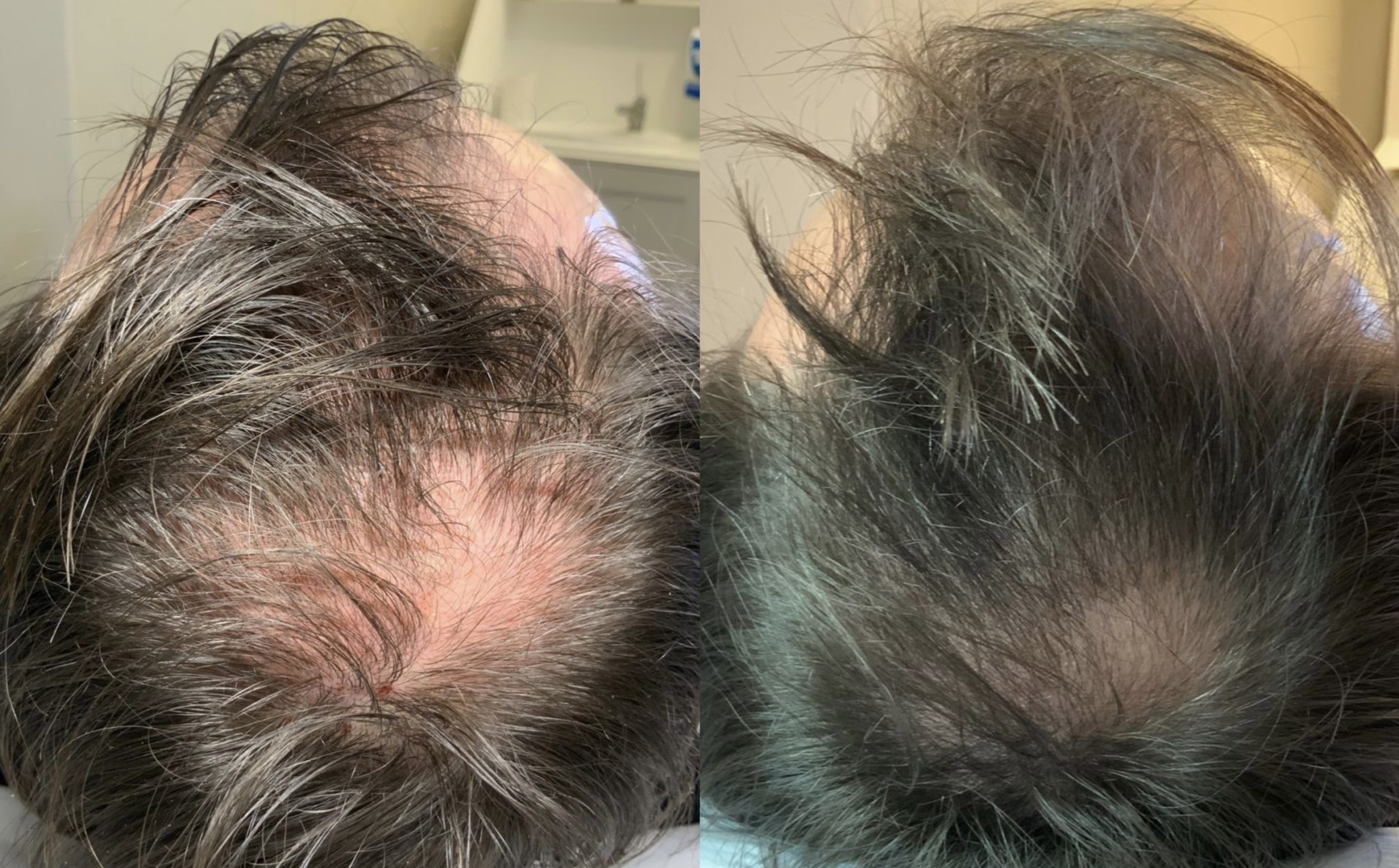 Exosomes for hair loss Libbie Wallace Skin Clinic